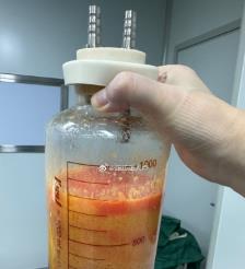 莱阳水动力吸脂手术要做多久？